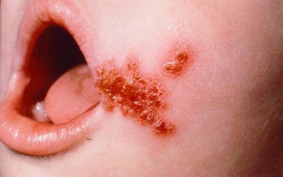 Enfermedades dermatologicas en niños